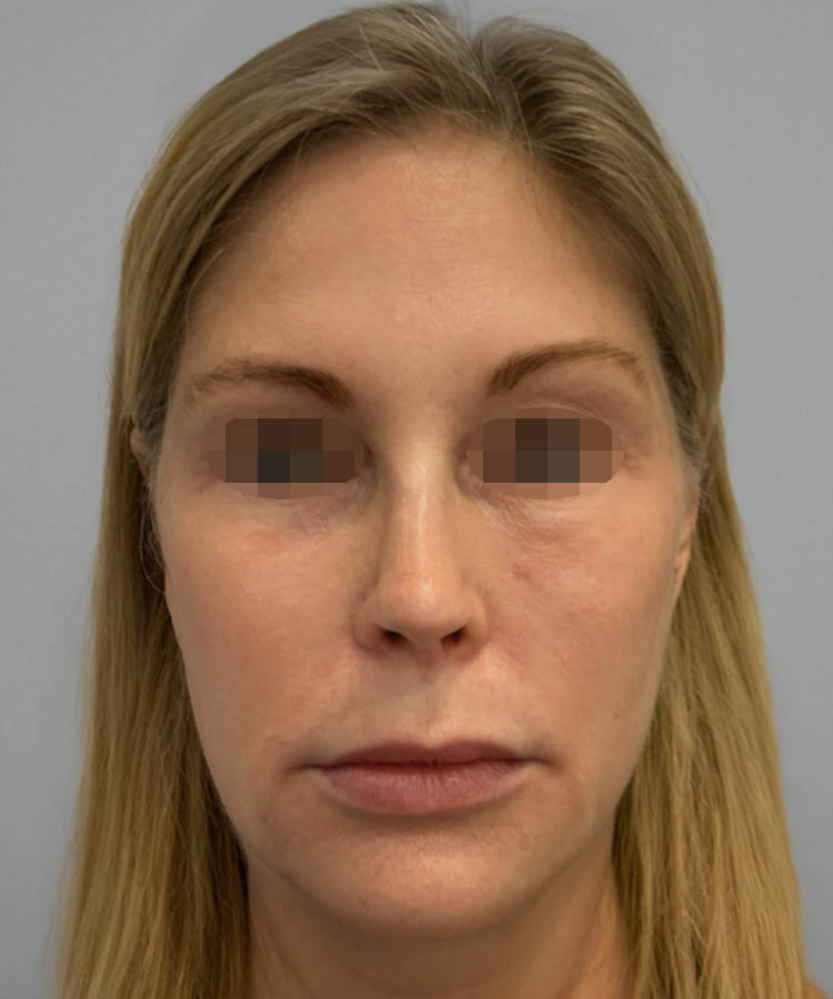 1_0000_Facelift1-1.png copy