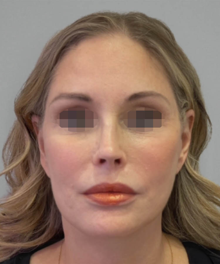 1_0001_Facelift1-1.png