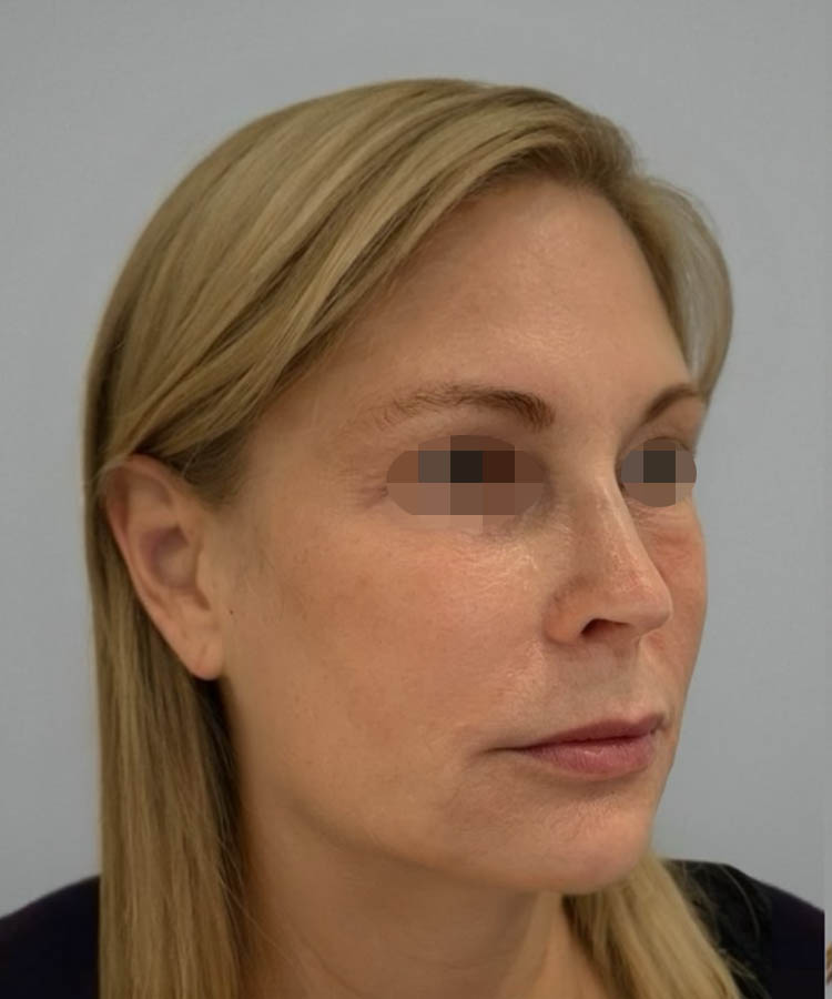 1_0002_Facelift1-2.png copy 2