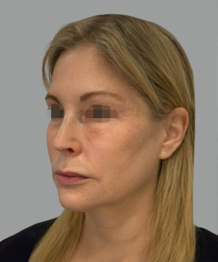 1_0004_Facelift1-3.png copy