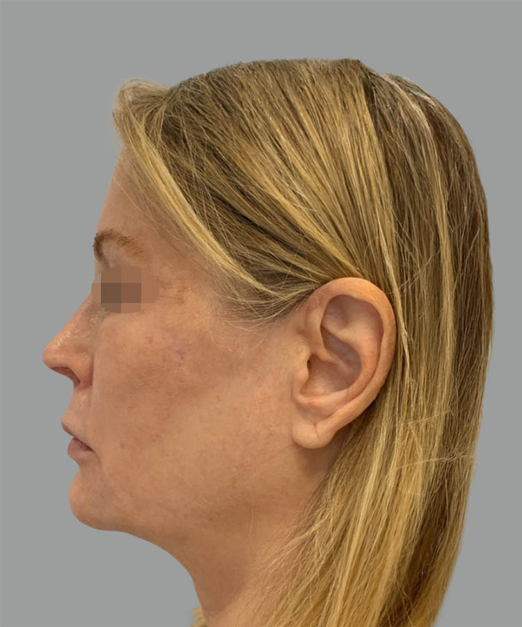 1_0006_Facelift1-4.png copy