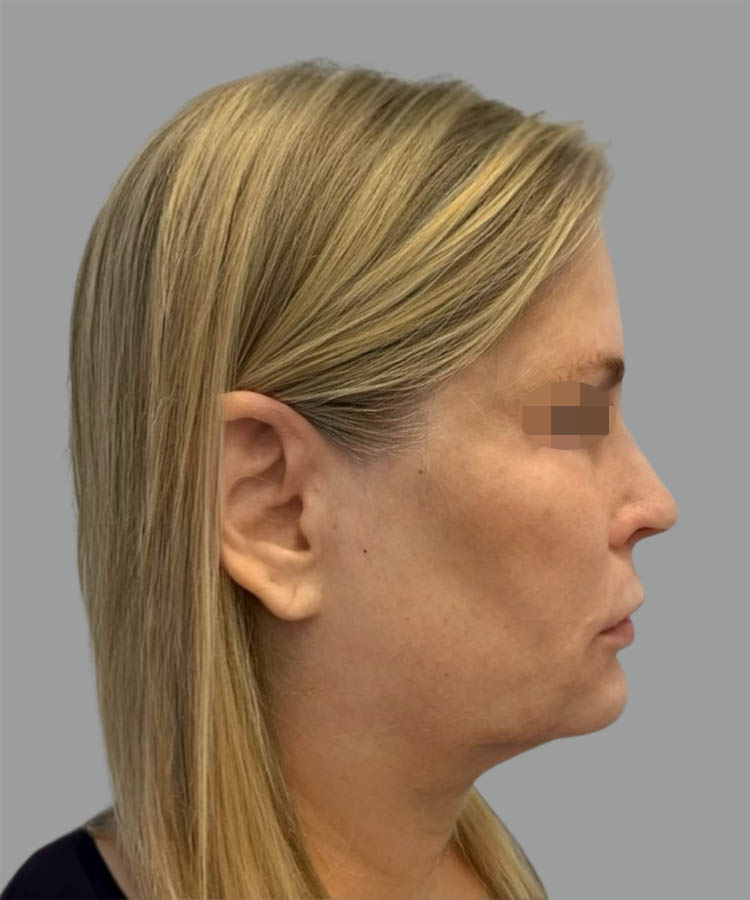 1_0008_Facelift1-5.png copy