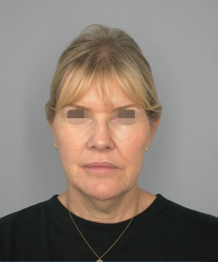 1_0010_Facelift2-1.png copy 2