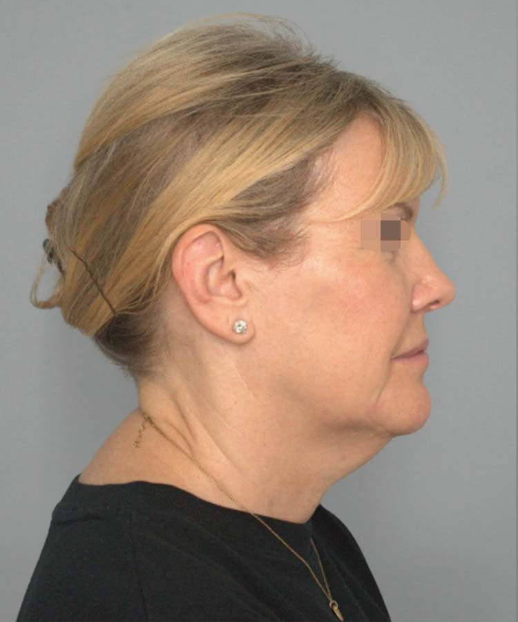 1_0016_Facelift2-4.png copy