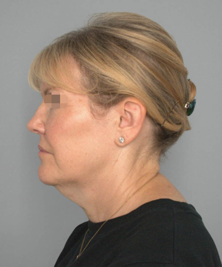 1_0018_Facelift2-5.png copy