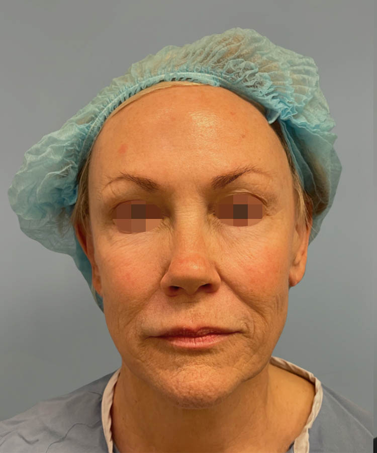 1_0030_Facelift4-1.png copy