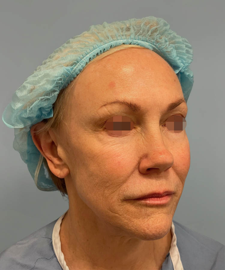 1_0034_Facelift4-3.png copy