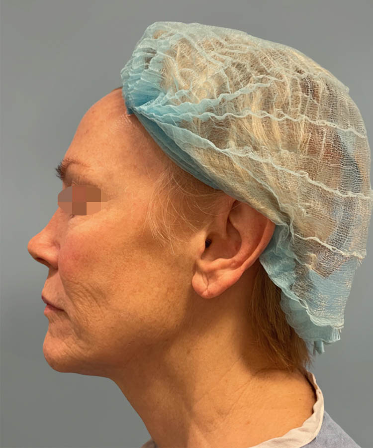 1_0036_Facelift4-4.png copy