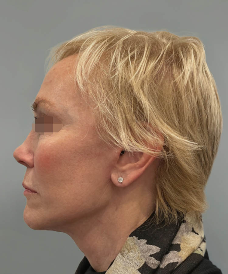 1_0037_Facelift4-4.png