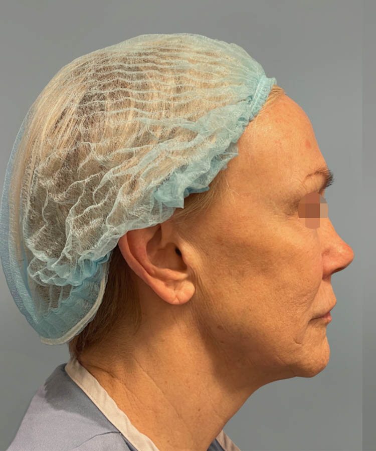 1_0038_Facelift4-5.png copy