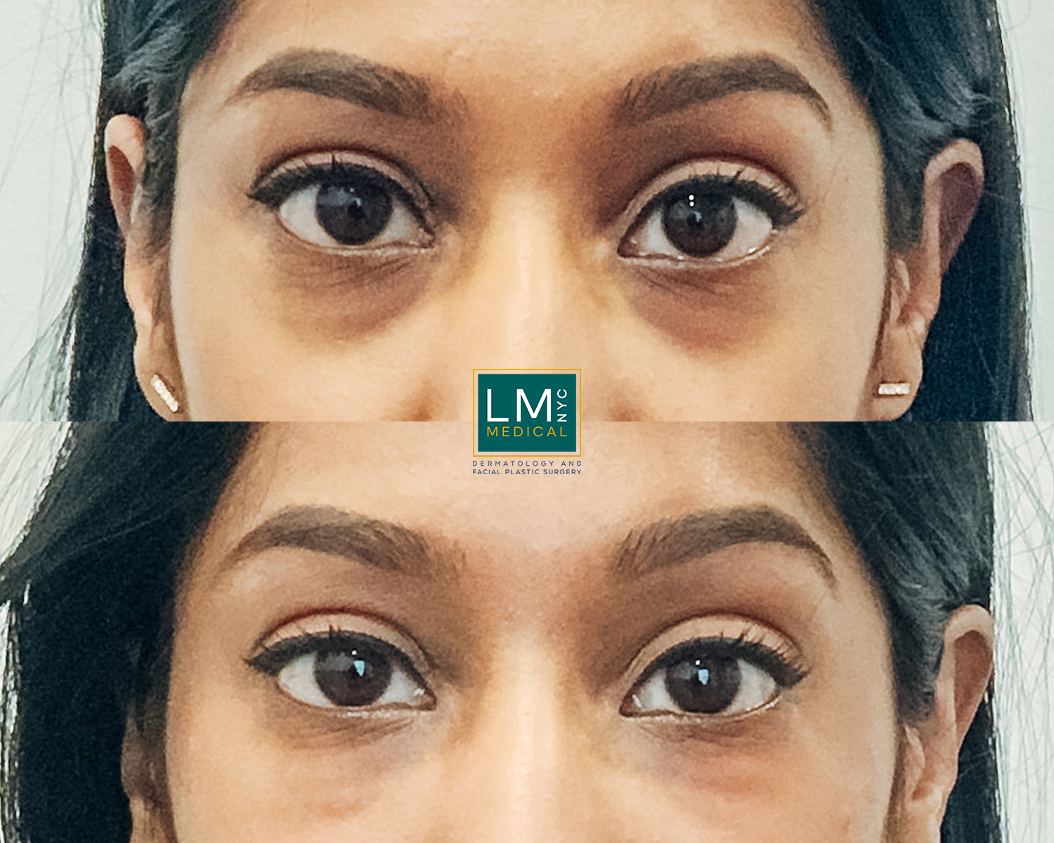 UnderEyeFiller12
