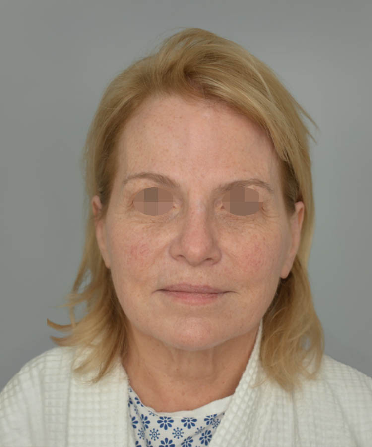 1_0020_Facelift3-1.png copy