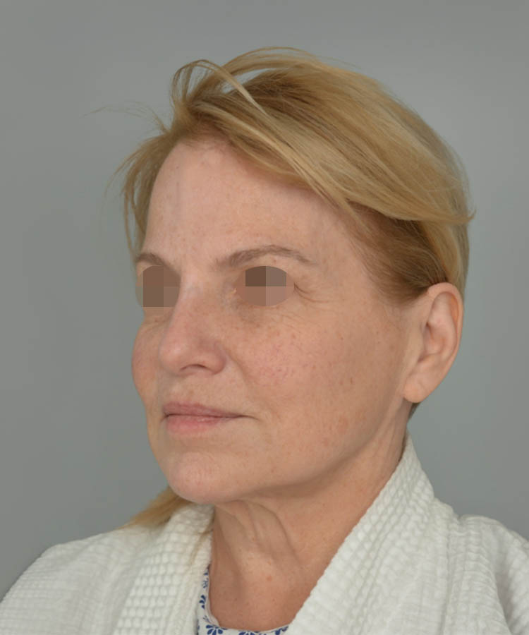 1_0022_Facelift3-2.png copy