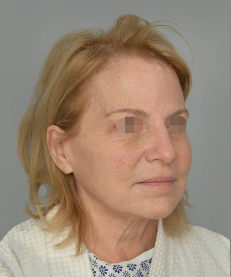 1_0024_Facelift3-3.png copy