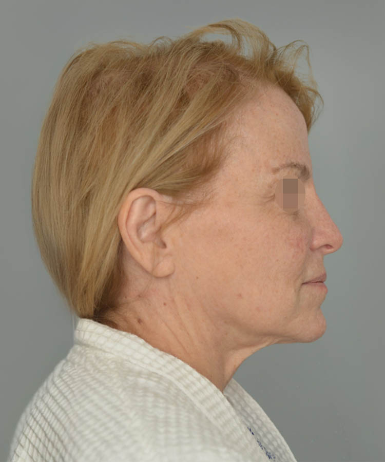 1_0026_Facelift3-4.png copy