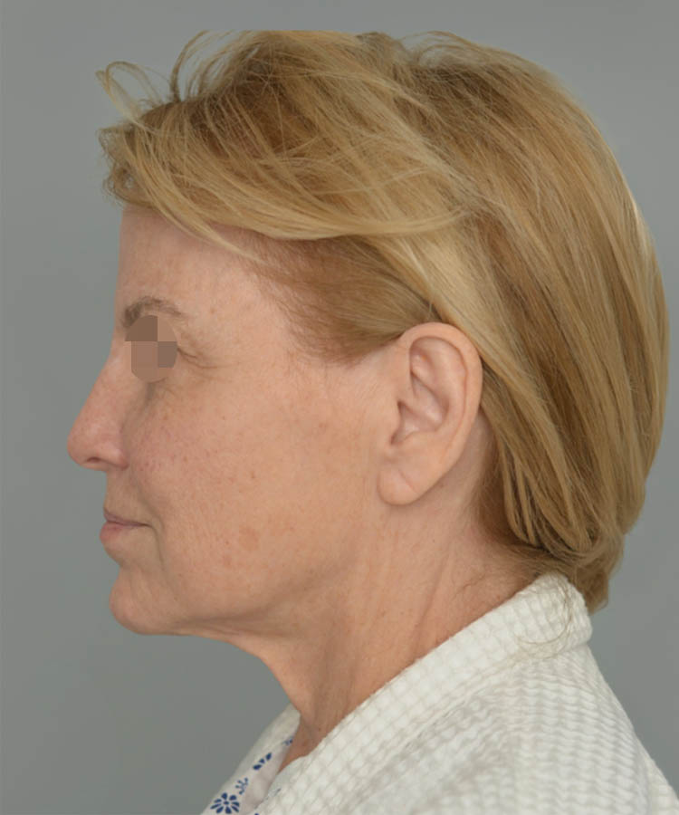 1_0028_Facelift3-5.png copy