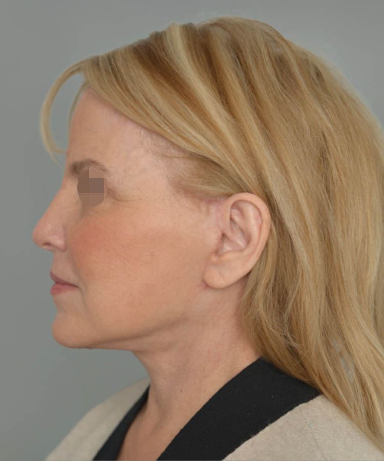 1_0029_Facelift3-5.png