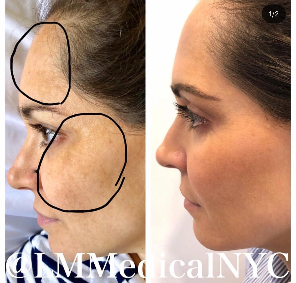 Chemicalpeel2