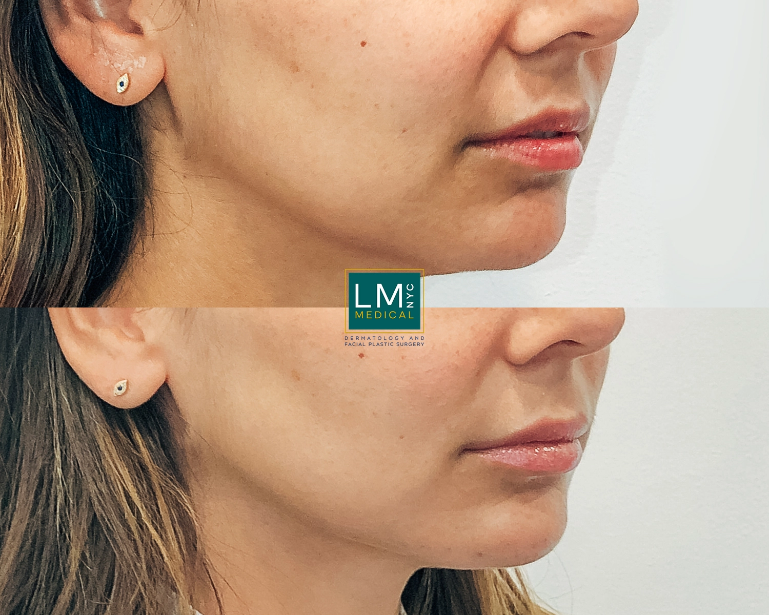 ChinLipJawFiller2