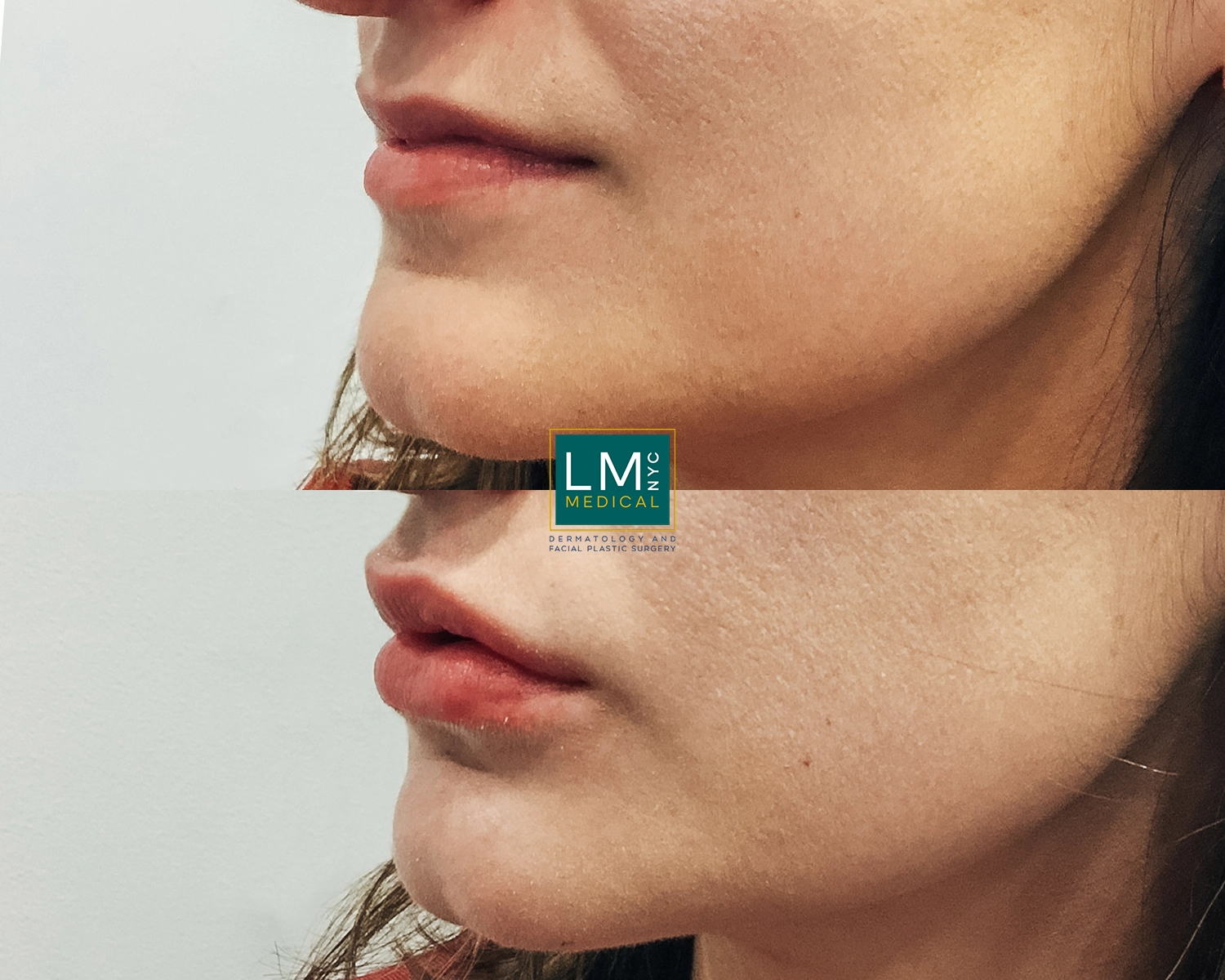 LipFiller5 (1)