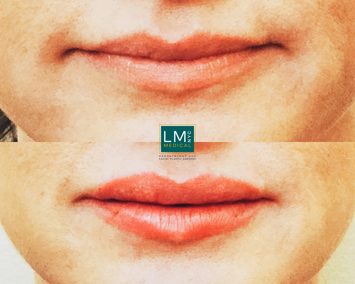 Lips1
