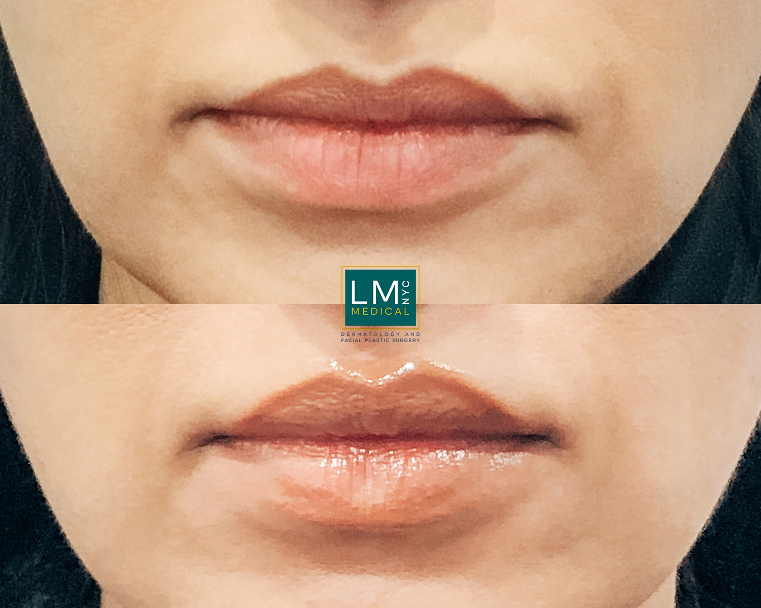 Lips6