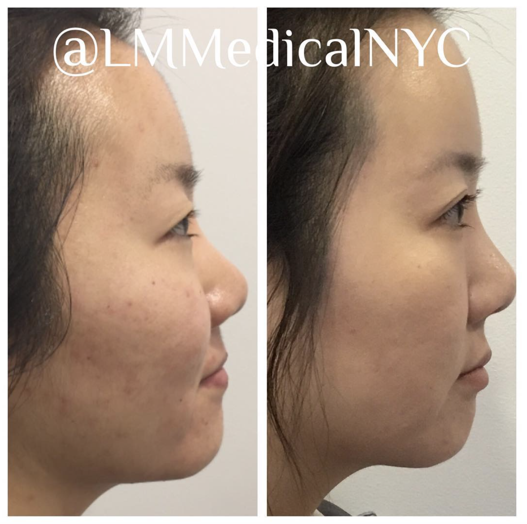 Microneedling1