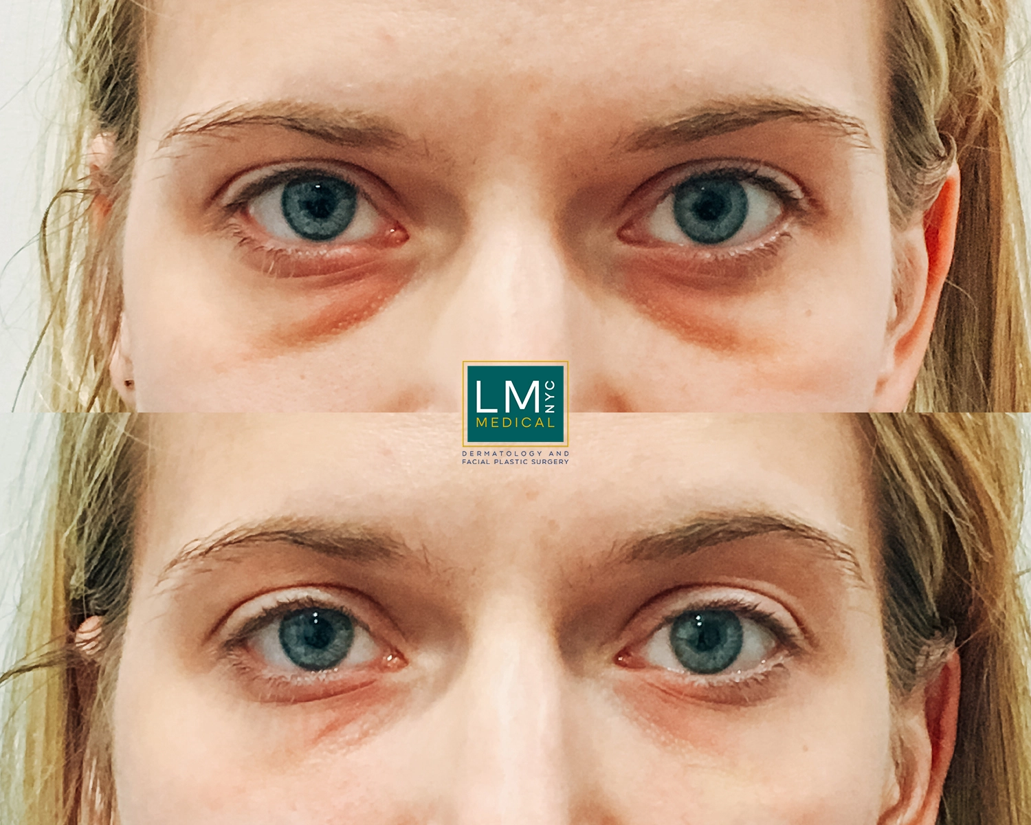 UnderEyeFiller2