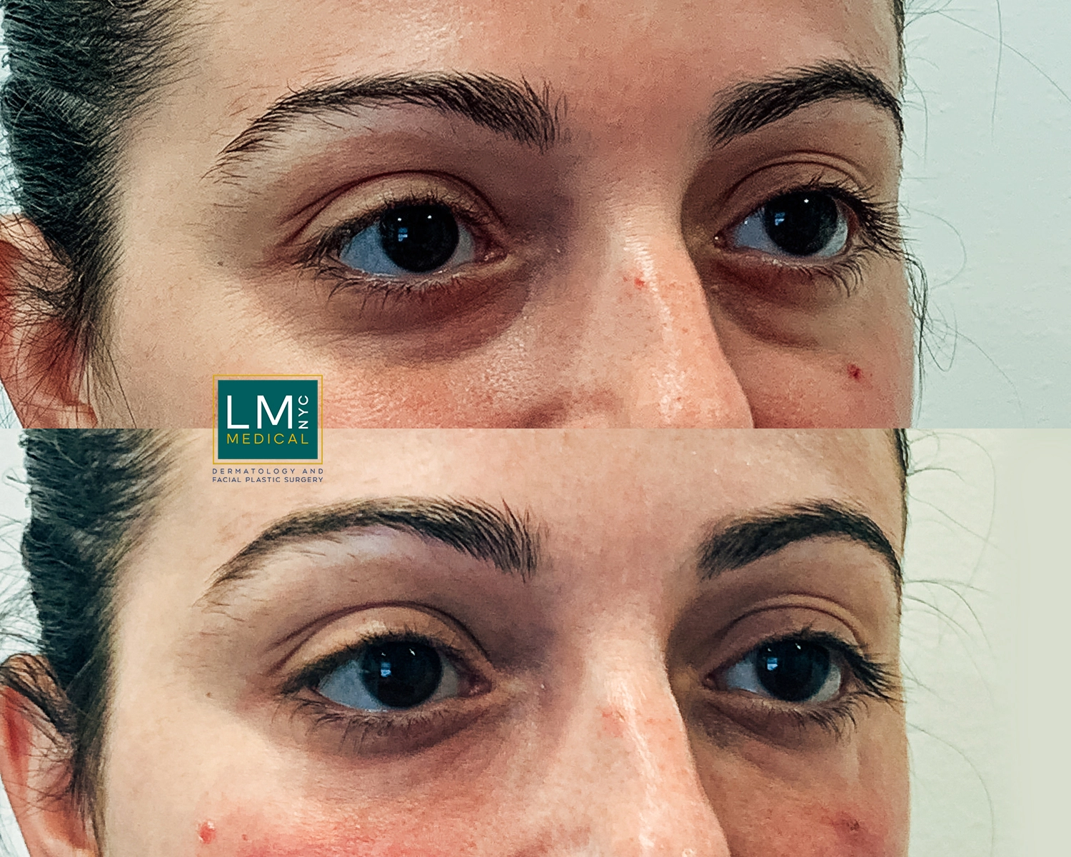 UnderEyeFiller21 2