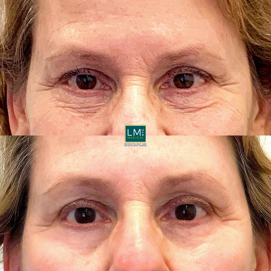 front Eyes Chemical Peel