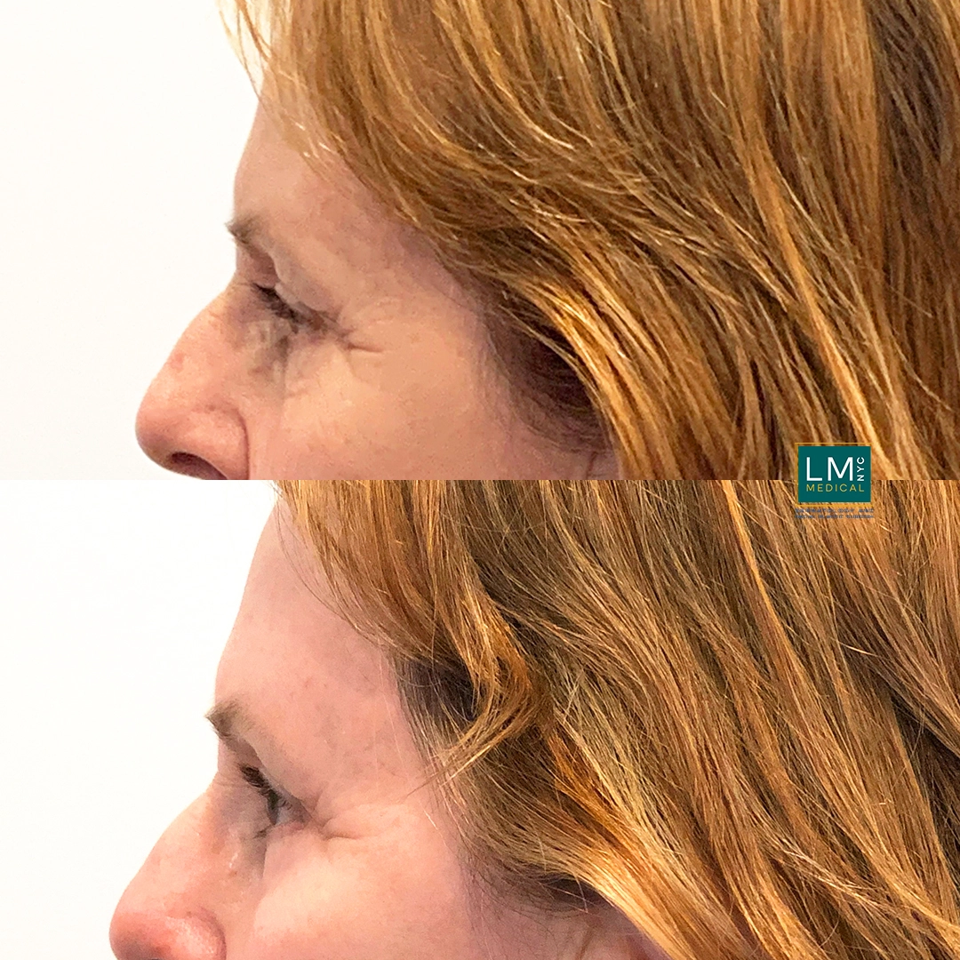 left Eyes Chemical Peel copy