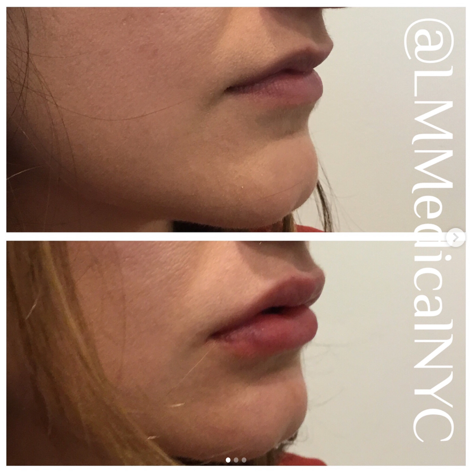 lipfiller1