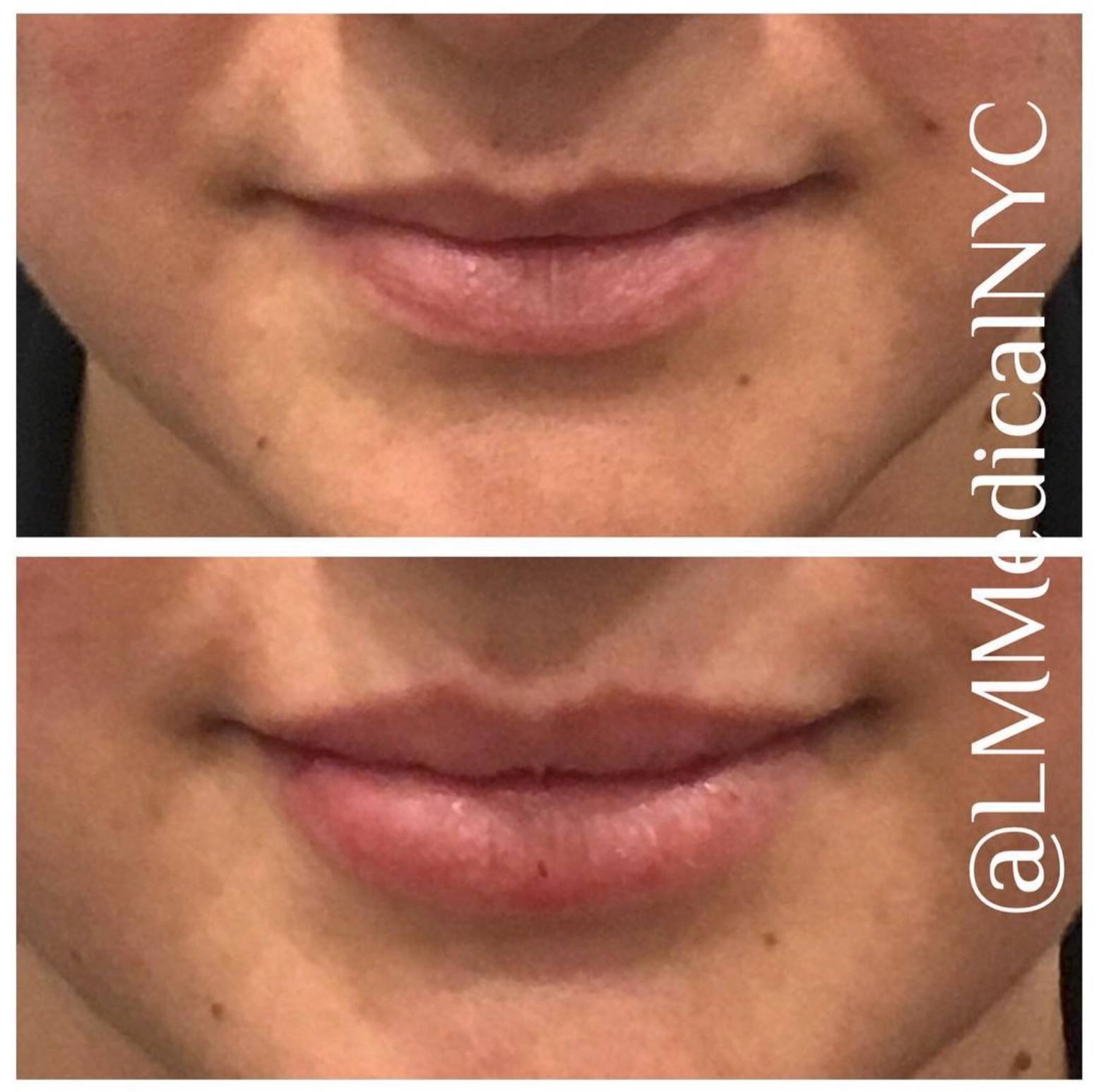 lipfiller3