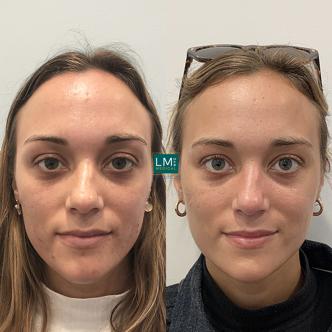 microneedling b&a front copy