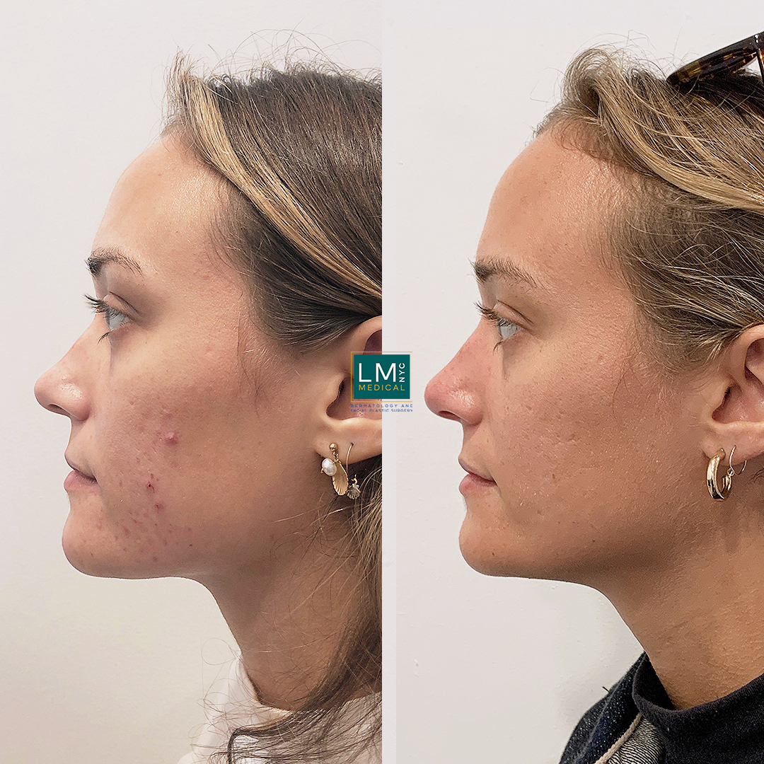 microneedling b&a left copy