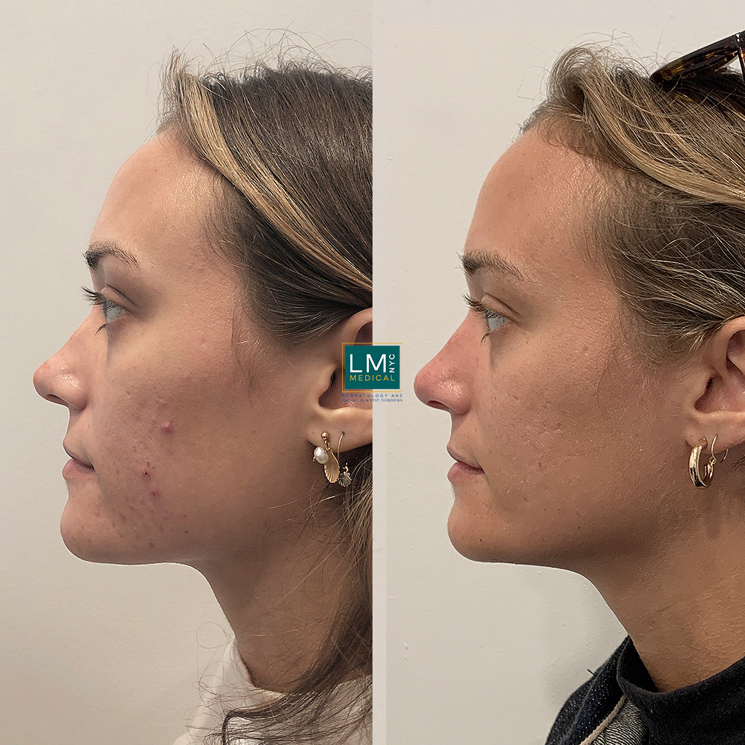 microneedling b&a left