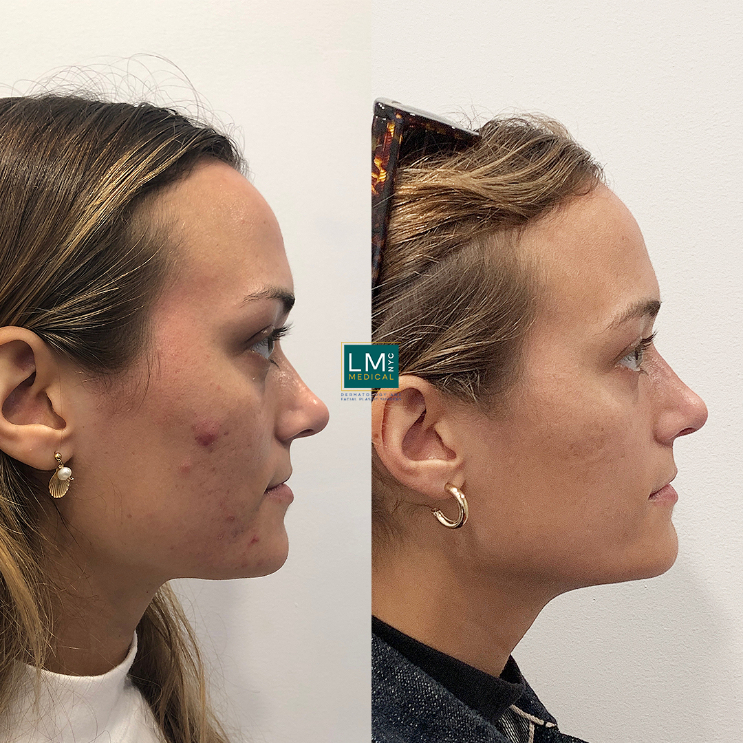 microneedling b&a right