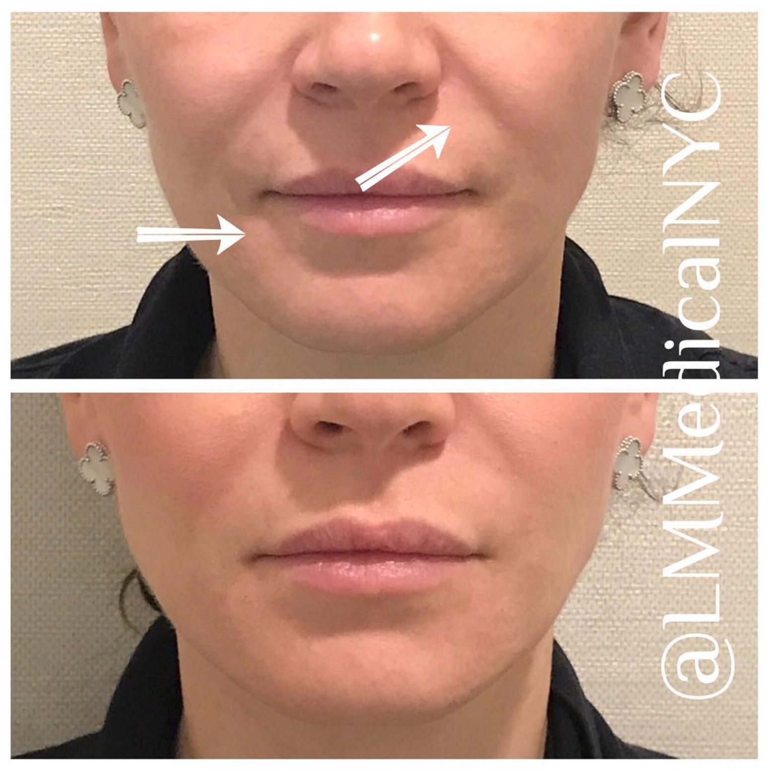 nasolabialfoldfiller1