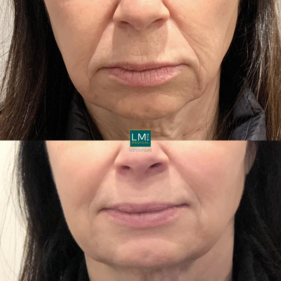 no surgery mouth front