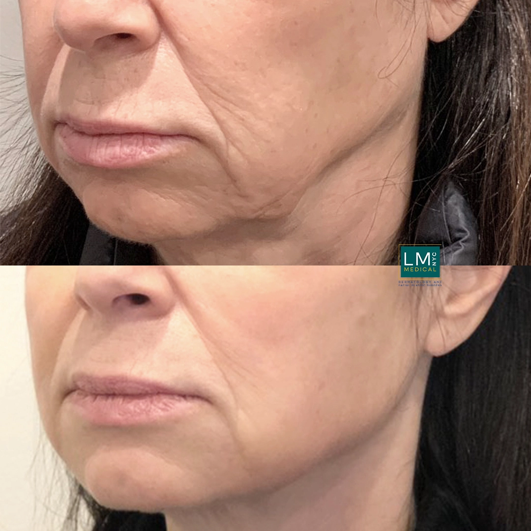 no surgery mouth left qtr