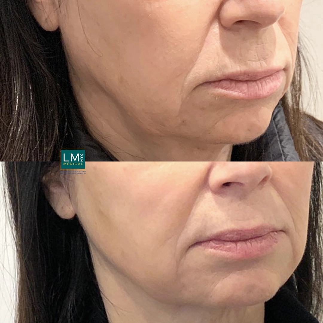 no surgery mouth right qtr