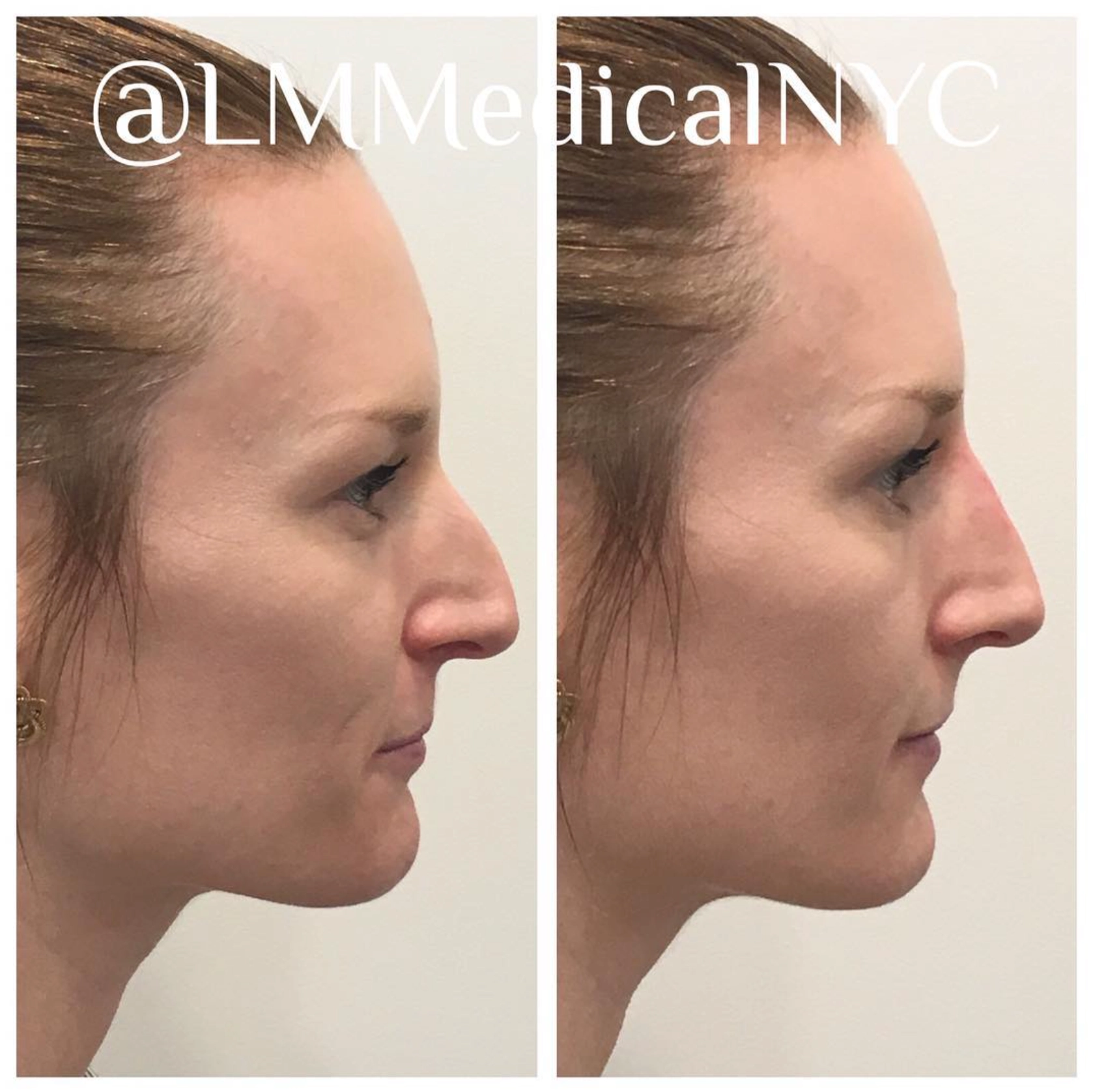 nosefiller4