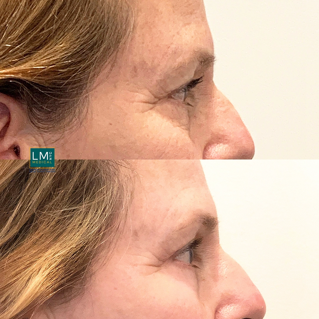 right Eyes Chemical Peel copy