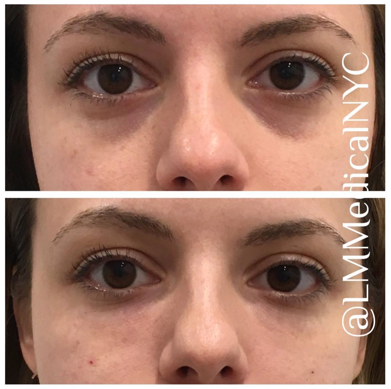 undereyefiller19.jpg.