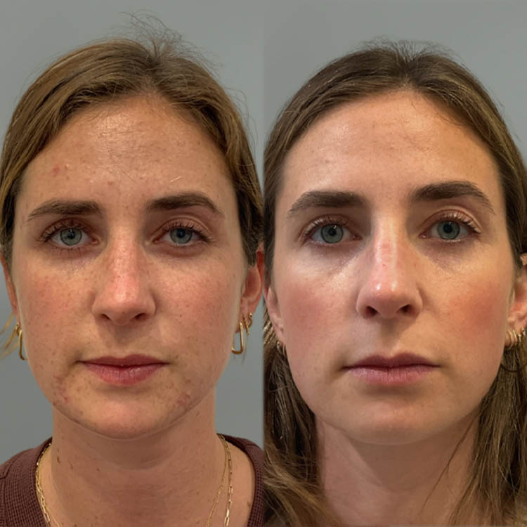 1_0008_SK_012_2025_PreOp_Front.png