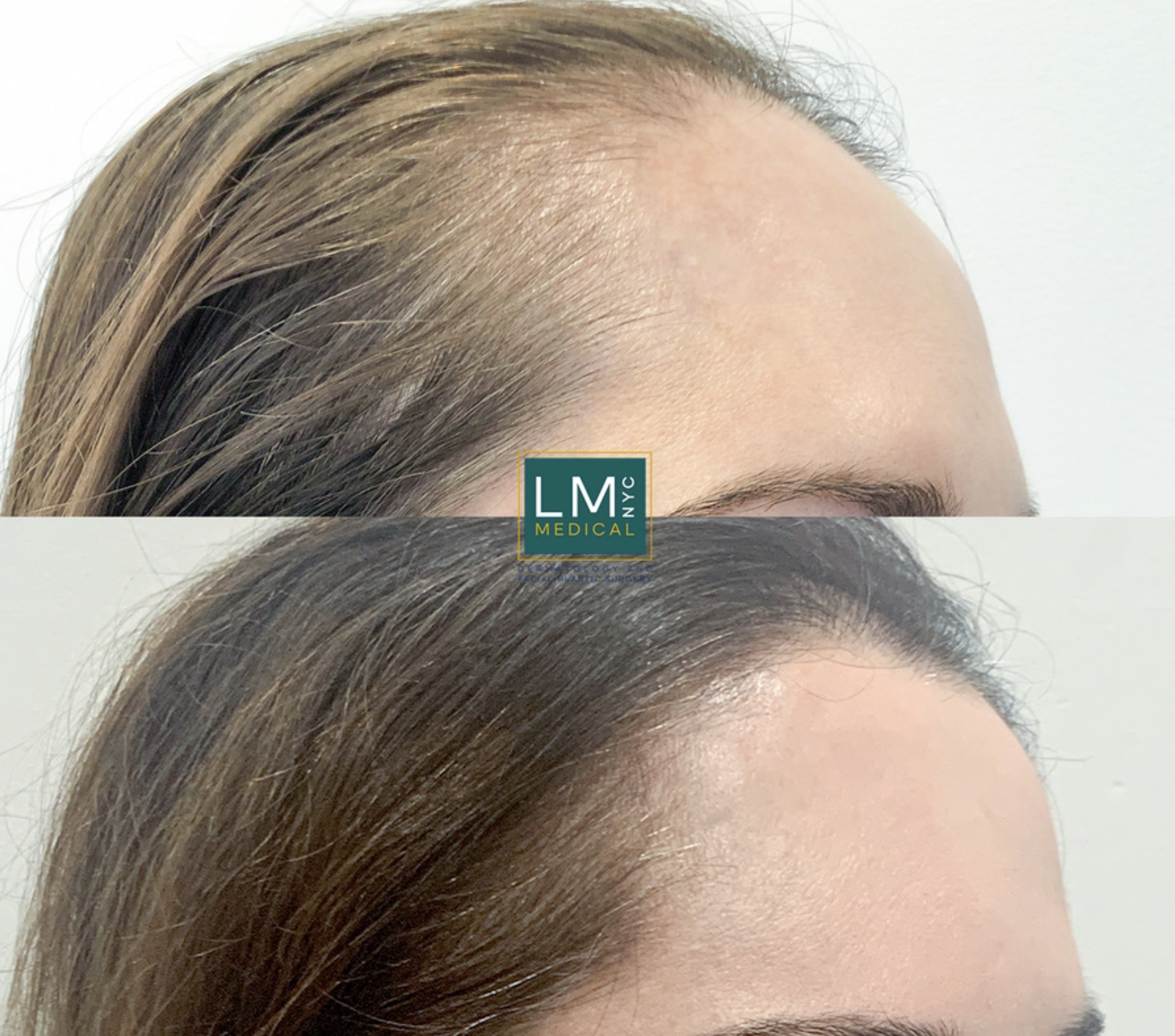 Hair Tx lateralL -1