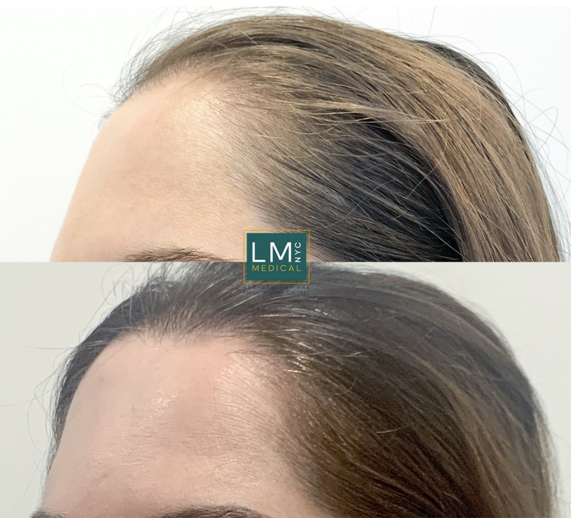 Hair Tx lateralR -1