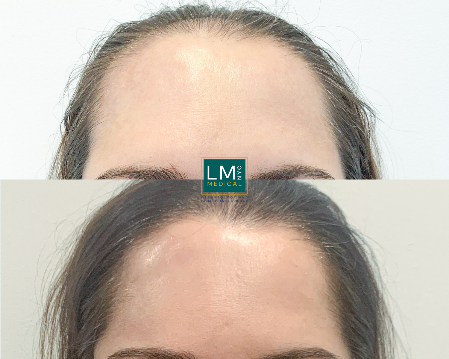 hairtransplant1 (1)