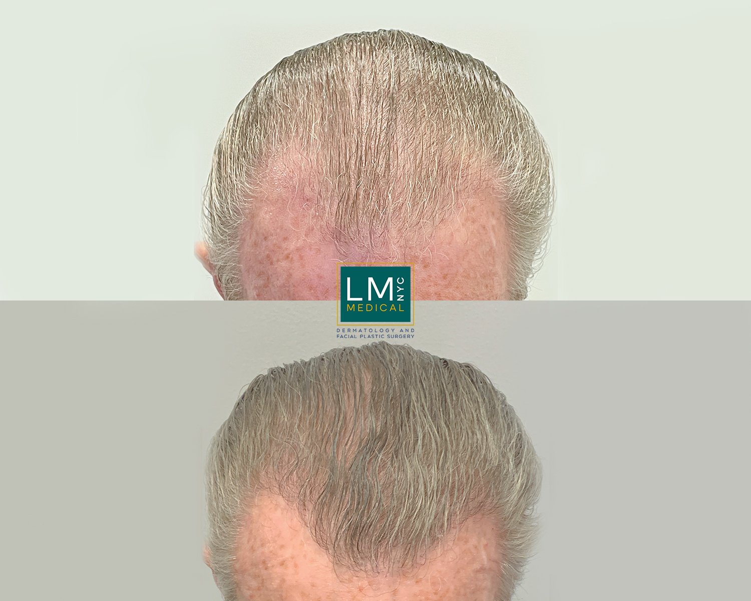 hairtransplant2 (1)