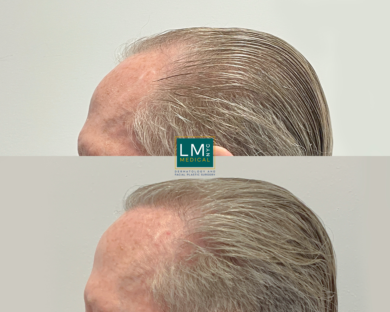 hairtransplant3 (1)